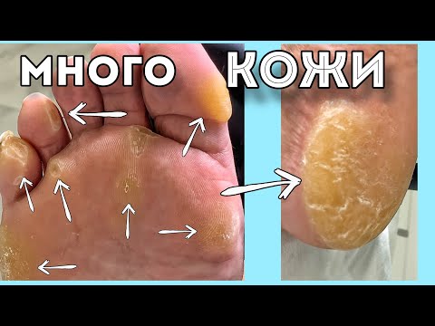 Видео: Много мозолей на одной стопе 😨