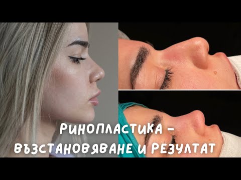 Видео: Ринопластика част 3 - възстановяване и резултат