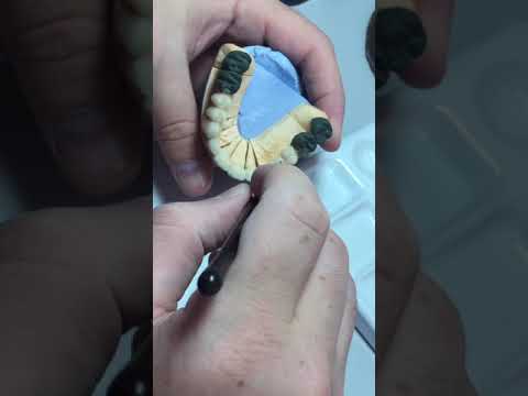 Видео: Нанесение глазури на металлокерамике.