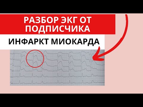 Видео: Инфаркт миокарда. Разбор ЭКГ от подписчика.