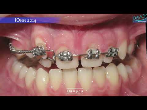 Видео: Транспозиция на резец с кучешки зъб на 4 K!