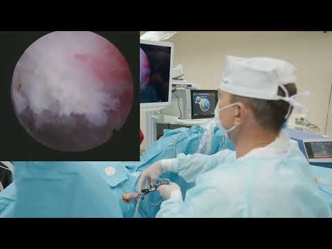 Видео: Лазерная энуклеация гиперплазии простаты объемом 100 см3 с использованием гольмиевого лазера