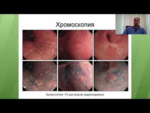 Видео: Диагностические возможности современной эндоскопии пищевар. системы. Е. Г. Солоницын, Д. Г. Баранов