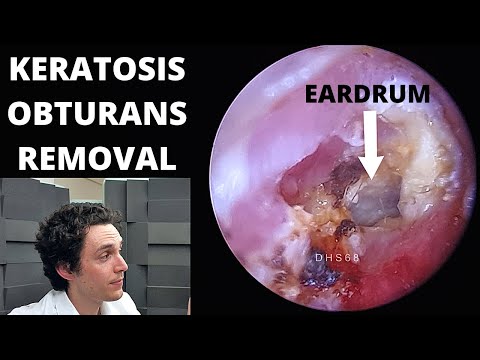 Видео: Удаление обтурирующего кератоза низкой степени с легким кровотечением (плотное скопление кожи в у...