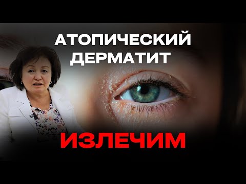 Видео: АТОПИЧЕСКИЙ ДЕРМАТИТ - ИЗЛЕЧИМ