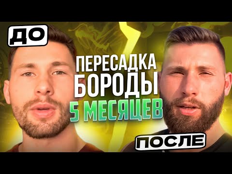 Видео: Пересадка бороды / Что стало с бородой через 5 месяцев / Выпуск 19 / Андрей борода