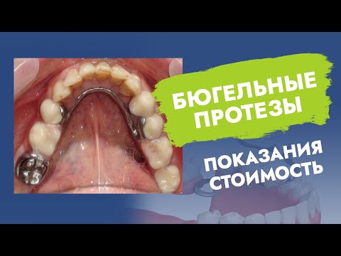 Видео: Бюгельные протезы. Показания. Стоимость.