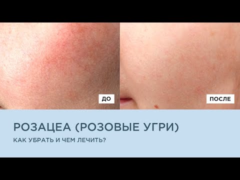 Видео: РОЗАЦЕА. РОЗОВЫЕ УГРИ. Как убрать чем лечить?