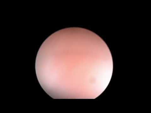 Видео: к арчи, риноскопия + фронтоскопия