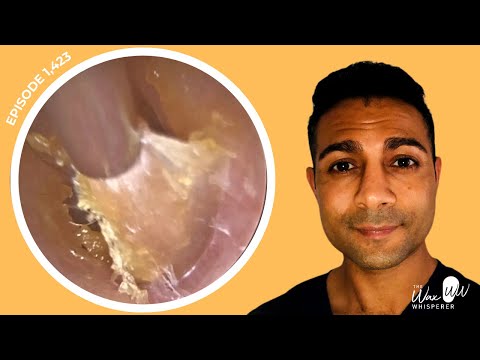 Видео: 1,423 - Сборник средств для отшелушивания омертвевшей кожи и удаления ушной серы | ПРИЗЫВАЕТ ПРЕЗ...