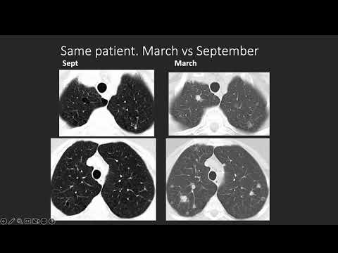 Видео: Вебинар на тему: "Патология легких связанная с курением"