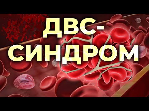 Видео: ДВС-синдром. Синдром диссеминированного внутрисосудистого свёртывания (коагулопатия потребления).