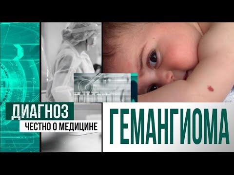 Видео: Гемангиома у детей: причины, особенности, удаление | Диагноз