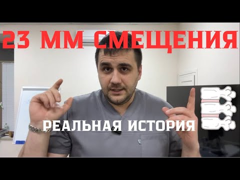 Видео: Смещение 23 мм! Упражнение, которое спасло. Реальная история