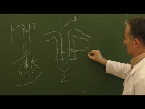 Видео: Схема желудочного свища по Штамму-Сенну-Кадеру