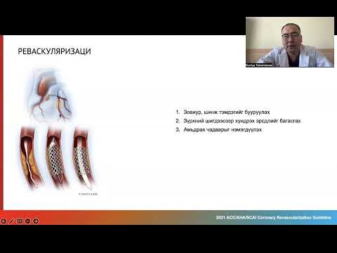 Видео: Зүрхний архаг ишеми өвчний үеийн стент тавих, судас залгах буюу реваскуляризаци эмчилгээ