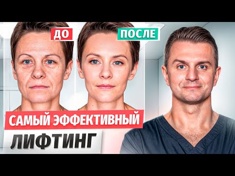 Видео: Правда про СМАС-лифтинг! Лечит или Калечит популярная процедура? [Ultraformer 3]