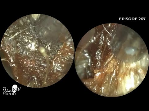 Видео: 267 - Сложное удаление ушной серы на дому с помощью WAXscope®️