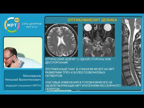 Видео: "МРТ в диагностике очаговых изменений спинного мозга"