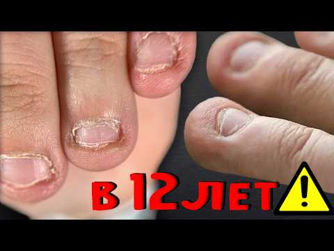 Видео: ЛИШИЛАСЬ НОГТЕЙ В 12 ЛЕТ?!😱 Наращивание РЕБЕНКУ.КАК ИСПРАВИТЬ НОГТЕВУЮ ПЛАСТИНУ?Преображение+ФИНАЛ