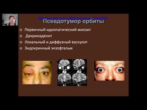 Видео: Патология орбиты, косоглазие