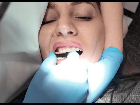 Видео: С большим трудом "пилим" мою твёрдую эмаль с плотнейшими контактами - всё ради элайнеров