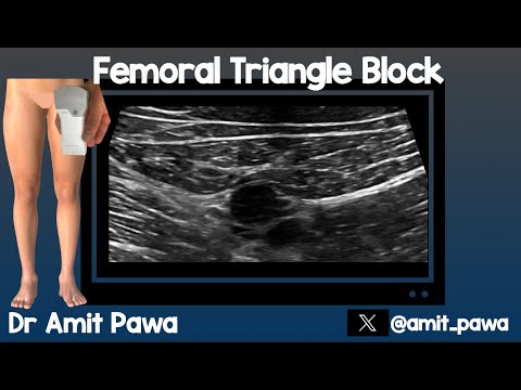 Видео: Блокада бедренного треугольника