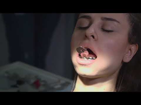 Видео: Методика получения точной окклюзионной картины на слепке с использованием К-силикона