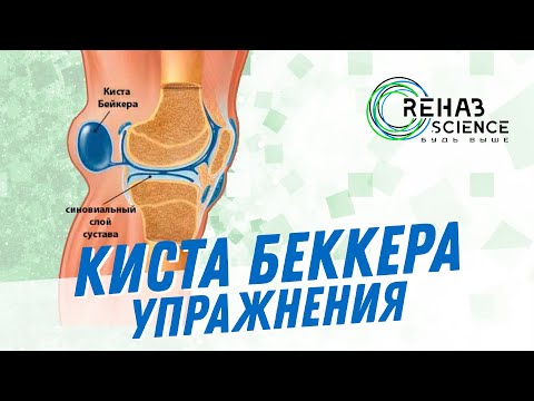 Видео: 💥Киста беккера💥