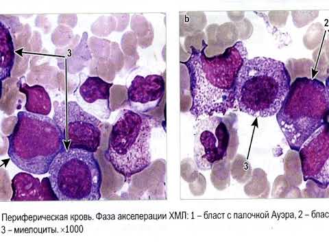 Видео: Лекция: «Лабораторная диагностика хронического миелолейкоза».