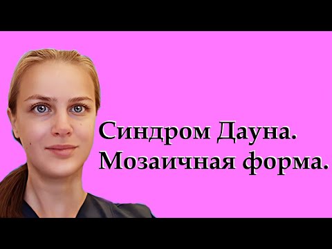 Видео: Синдром Дауна. Мозаичная форма. Кариотип. Признаки. Особенности.