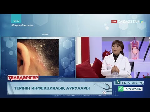 Видео: «ТЕЛЕДӘРІГЕР». Терінің инфекциялық аурулары