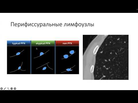 Видео: Вебинар на тему: "Особенности оценки лимфатических узлов на компьютерных томограммах"