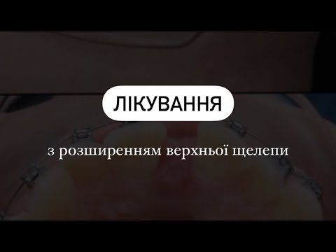 Видео: Лікування з розширенням верхньої щелепи | Ортодонт Б. Свінціцький