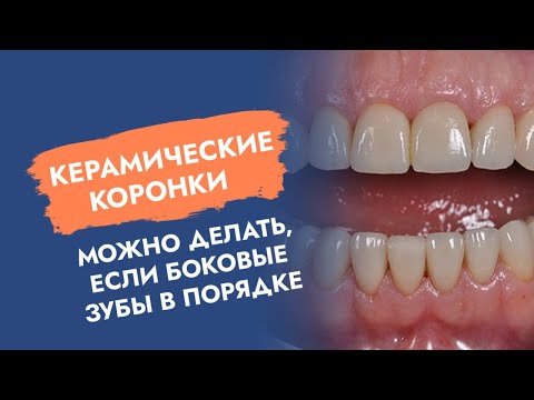 Видео: Керамические коронки! Можно делать, если боковые зубы в порядке.
