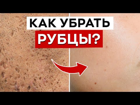 Видео: Как убрать шрамы от прыщей? / Как лечить постакне?