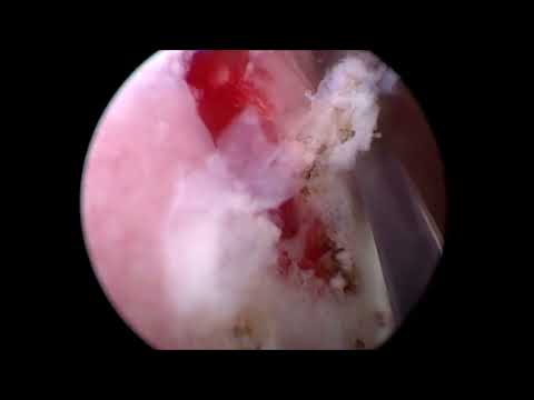 Видео: Лейкоплакия мочевого пузыря