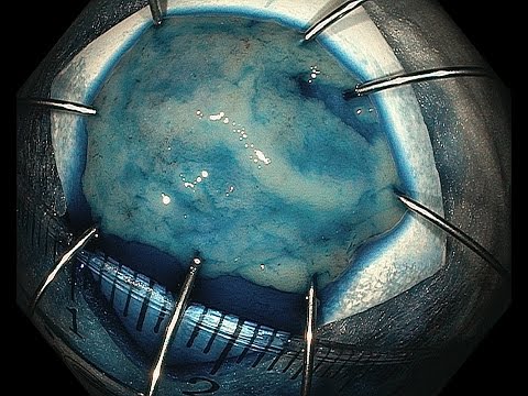 Видео: Colon EMR without cuts. Эндоскопическая резекция слизистой без купюр