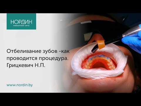 Видео: Отбеливание зубов - как проводится процедура, что такое "белая" диета