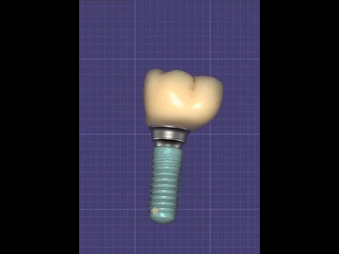 Видео: #exocad  #dentaldesign #ZrO2 ЭКЗОКАД ДЛЯ ЧАЙНИКОВ коронка на индивидуальном абатменте диоксид цирона