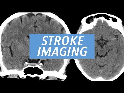 Видео: Результаты визуализации острого ишемического инсульта: обзор исследований головного мозга с помощ...