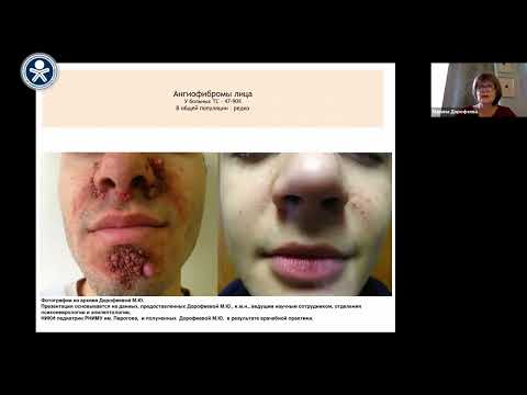 Видео: "Вельтищевские пятницы" Туберозный склероз. Вед. науч. сотр., к.м.н. Дорофеева М.Ю.