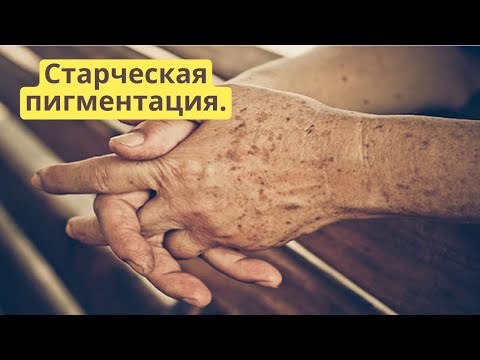 Видео: Старческая пигментация и весна. Что нужно знать про возрастную пигментацию?