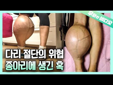 Видео: 30-летний мужчина, страдающий саркомой, у него огромная шишка на икре ..