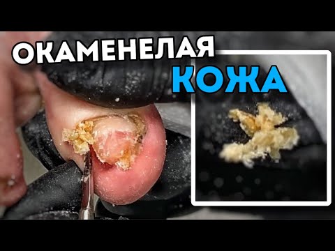 Видео: Кожный агломерат в боковом валике | #подологтатьянапак