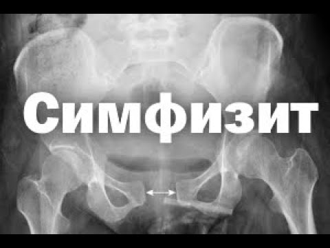 Видео: Симфизит. Кесарево. История родов.