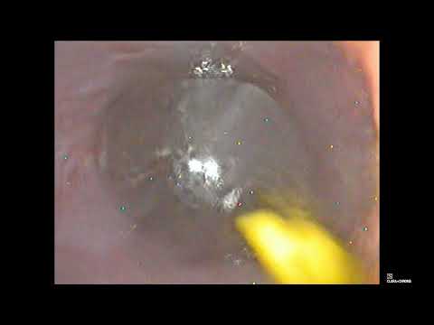 Видео: Баллонная дилатация стриктуры пищевода 5 процедура