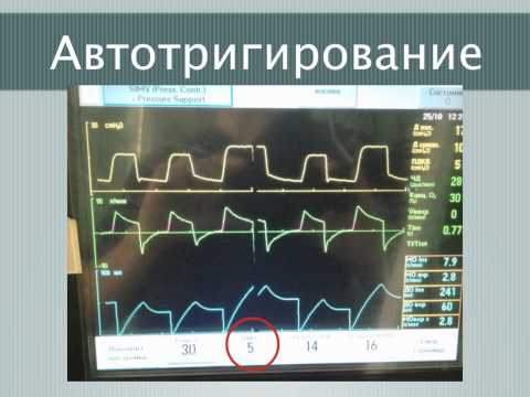 Видео: Асинхронность пациента и респиратора А.А.Полупан