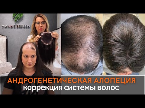 Видео: Коррекция системы замещения при андрогенетической алопеции