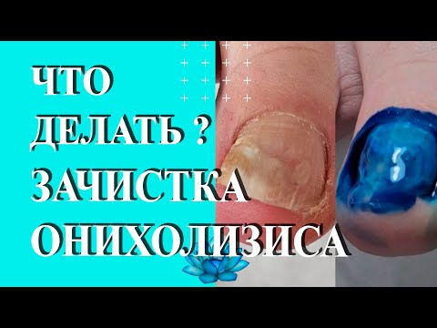 Видео: Онихолизис ногтей на ногах. Ноготь отходит от ногтевого ложа.
